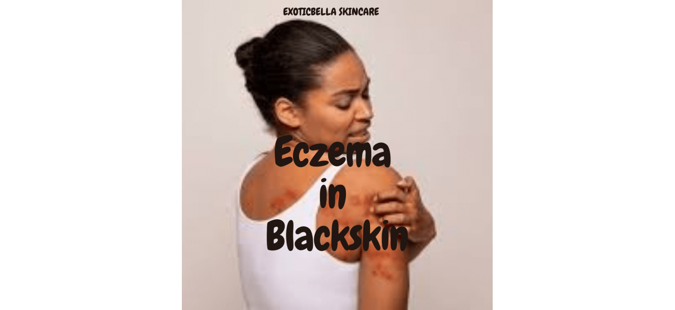 Understanding Eczema in Black Skin